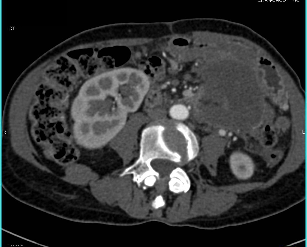 Necrotic Carcinoma of the Tail of the Pancreas with Liver Metastases - CTisus CT Scan