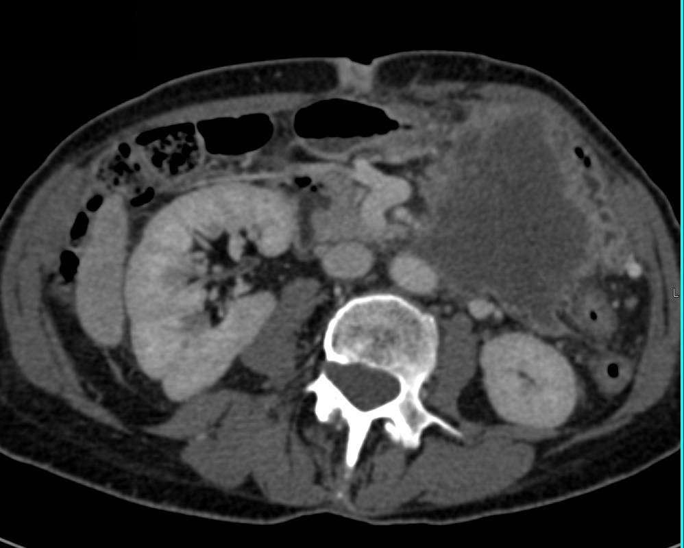 Carcinoma of the Tail of the Pancreas with Liver Metastases - CTisus CT Scan