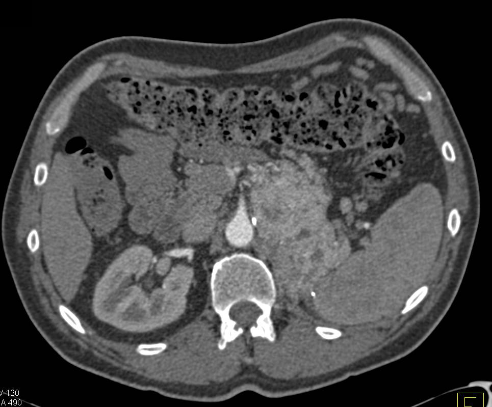 Recurrent Renal Cell Carcinoma Involves the Pancreas - CTisus CT Scan