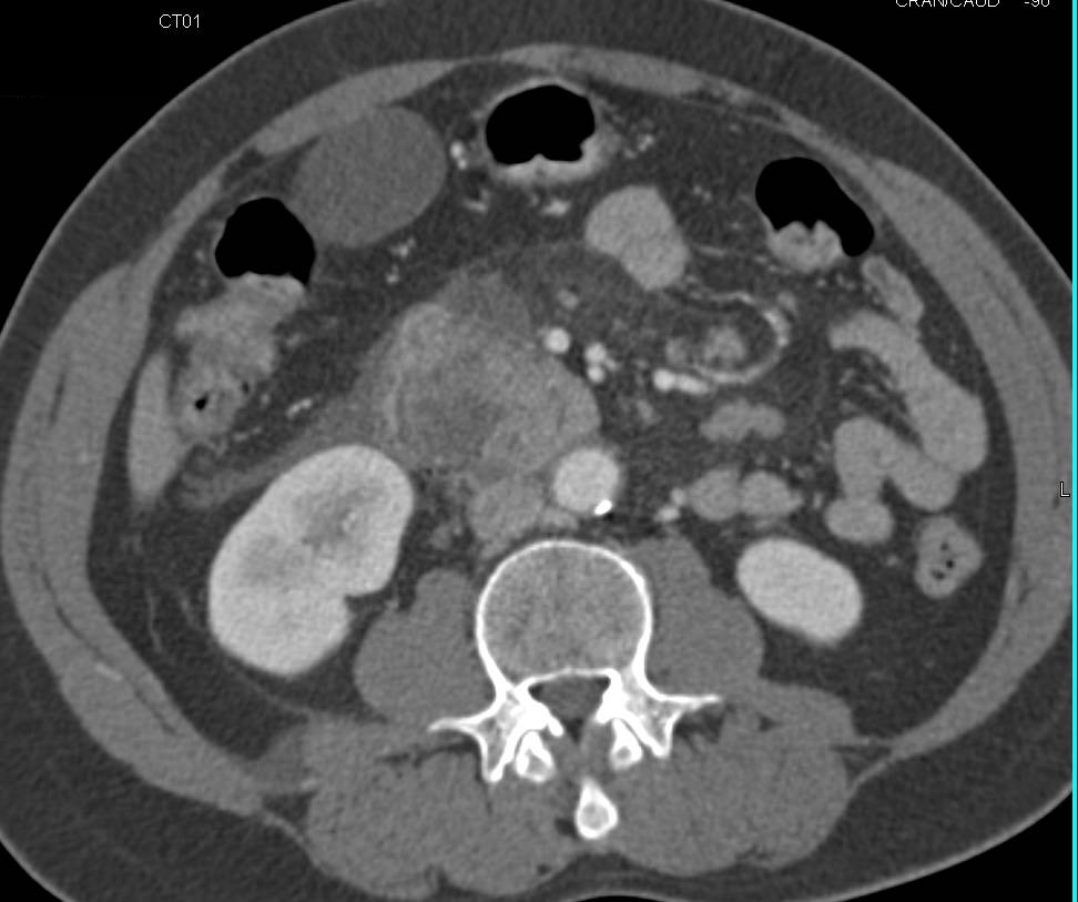 Acute Pancreatitis and Focal Perforation of Duodenum Following an Endoscopic Retrograde Cholangiopancreatography (ERCP) - CTisus CT Scan