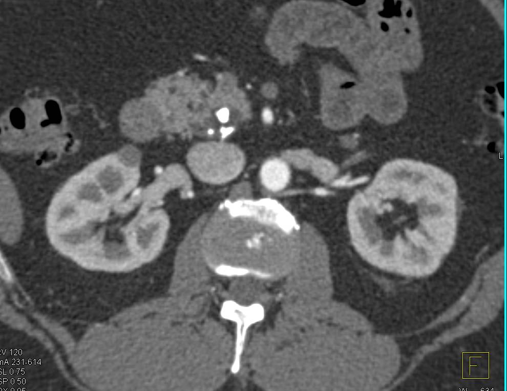 Cystic Lesion Head of Pancreas with Calcifications - CTisus CT Scan