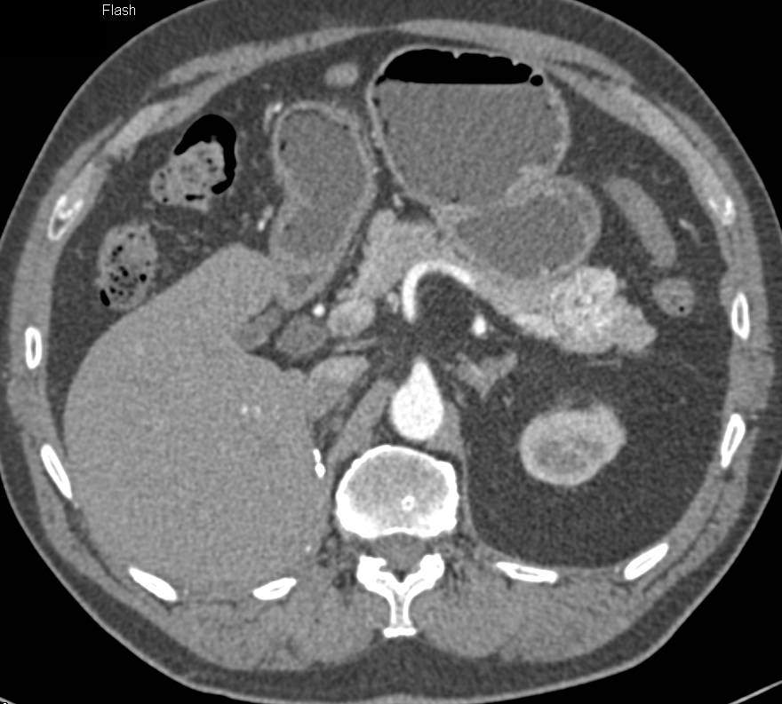 Metastatic Renal Cell Carcinoma to the Pancreas - CTisus CT Scan