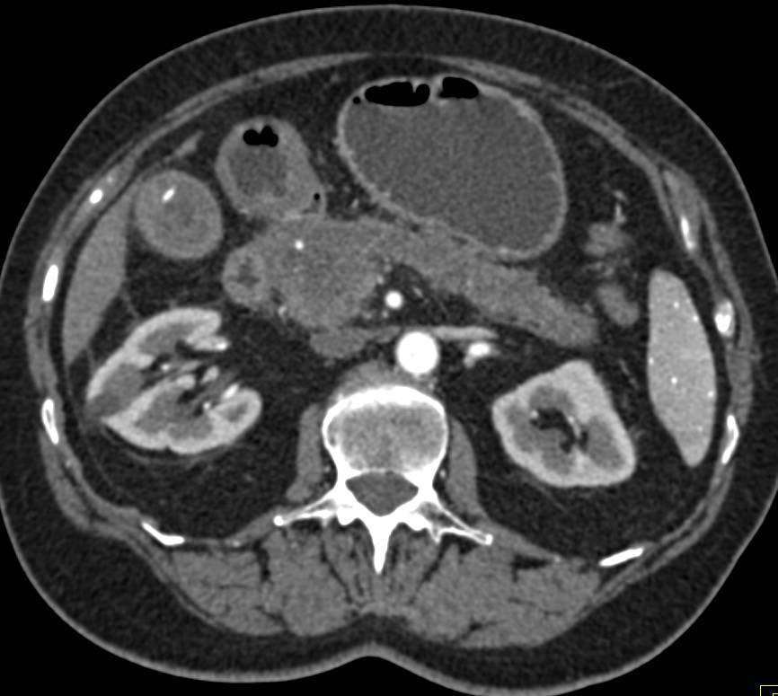 Carcinoma of the Pancreatic Head with Pancreatic Duct Obstruction - CTisus CT Scan