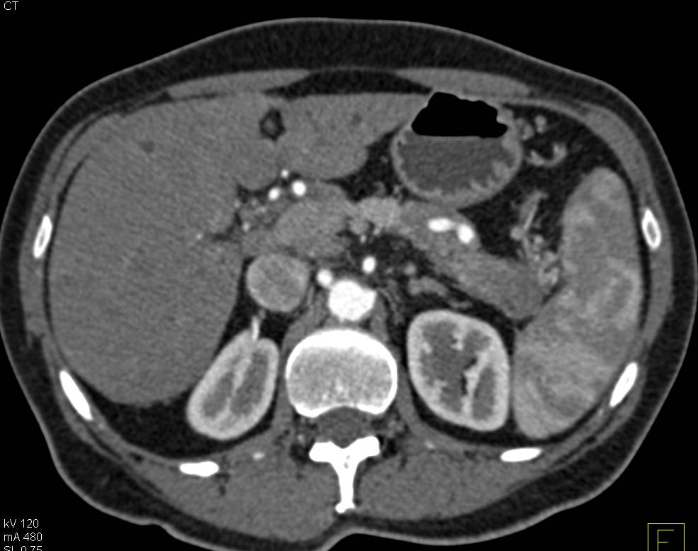 Adenocarcinoma Body of the Pancreas - CTisus CT Scan