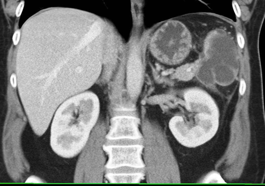Splenic Pseudocyst As A Result Of Prior Pancreatitis Pancreas Case