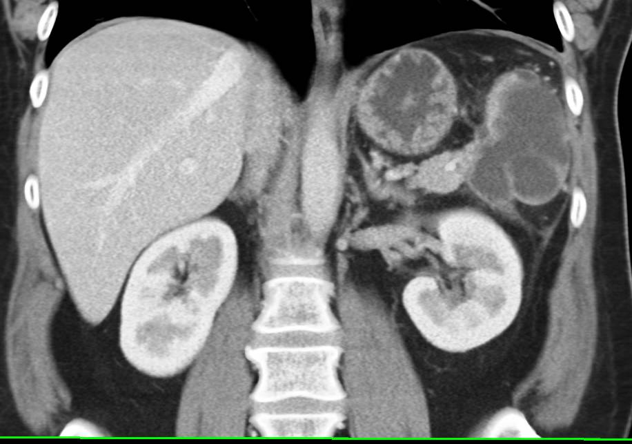 Splenic Pseudocyst as a Result of Prior Pancreatitis - CTisus CT Scan