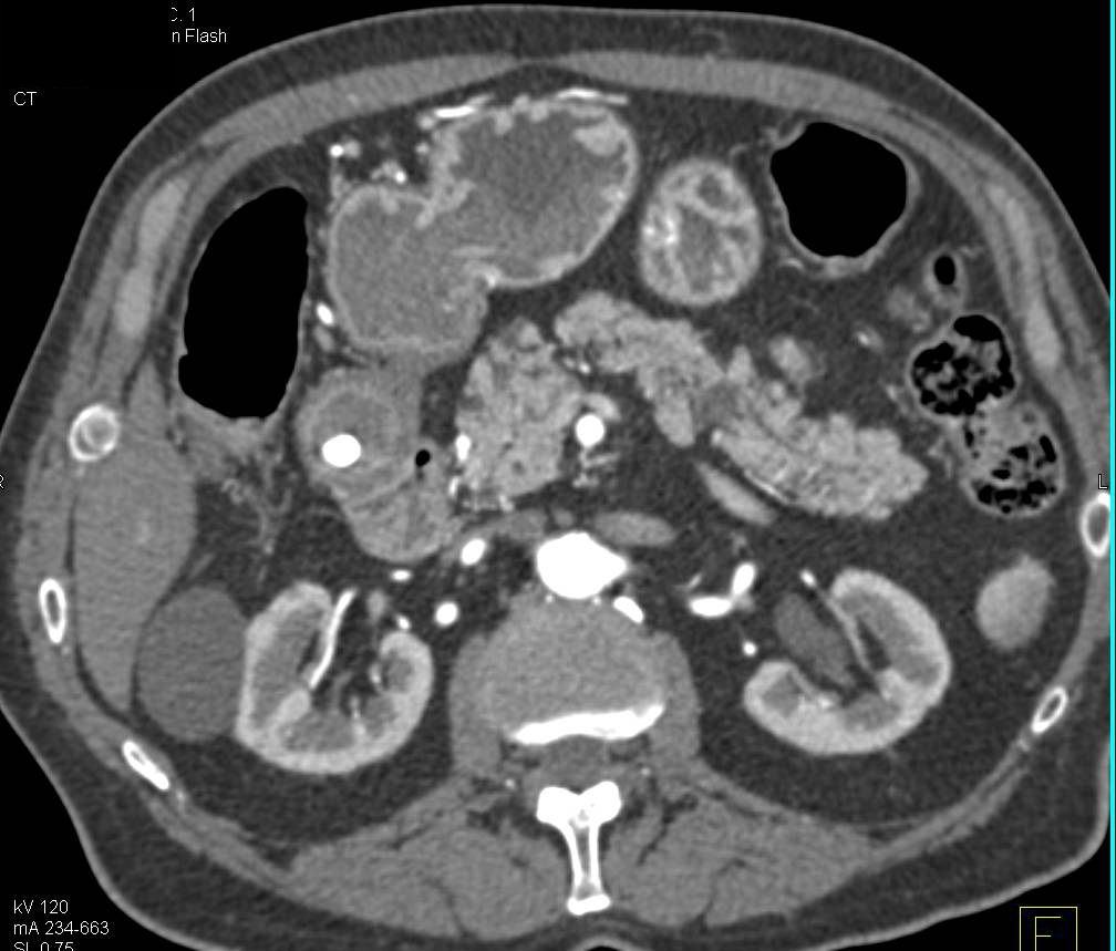 Multiple Intraductal Papillary Mucinous Neoplasms (IPMNs) - CTisus CT Scan