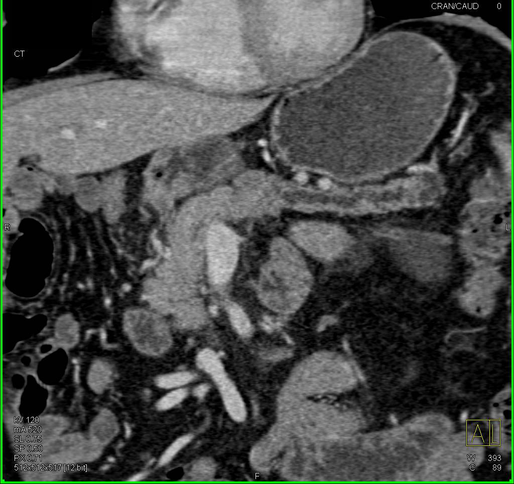 Subtle Carcinoma of the Body of the Pancreas with Distal Duct Dilatation - CTisus CT Scan