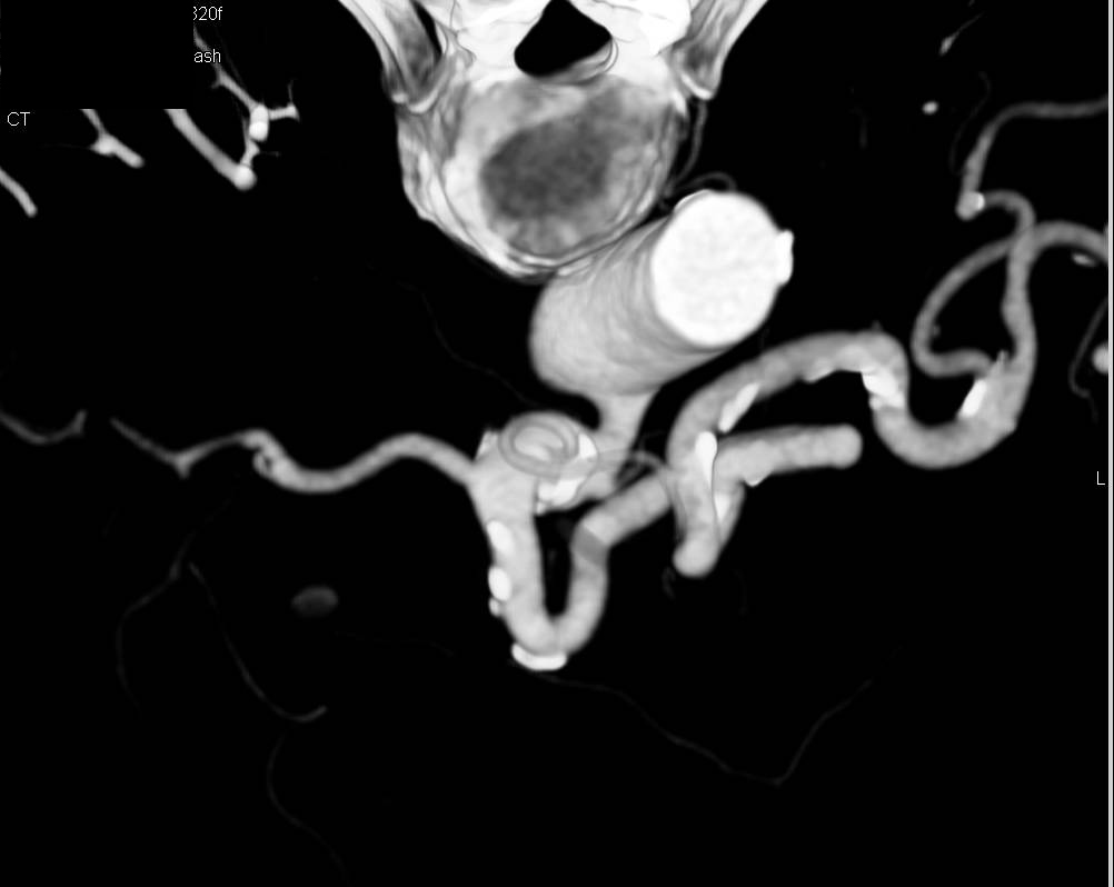 Complex Cystic Pancreatic Mass was Intraductal Papillary Mucinous Neoplasm (IPMN) at Surgery - CTisus CT Scan