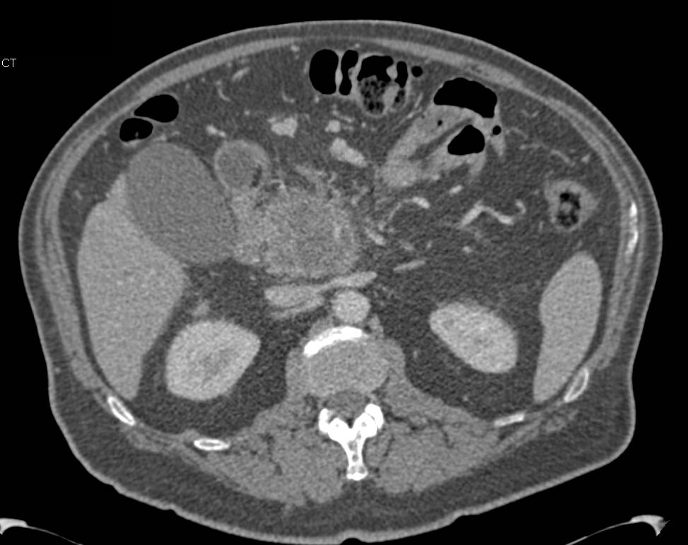 Pancreatic Adenocarcinoma with Arterial and Venous Involvement - CTisus CT Scan