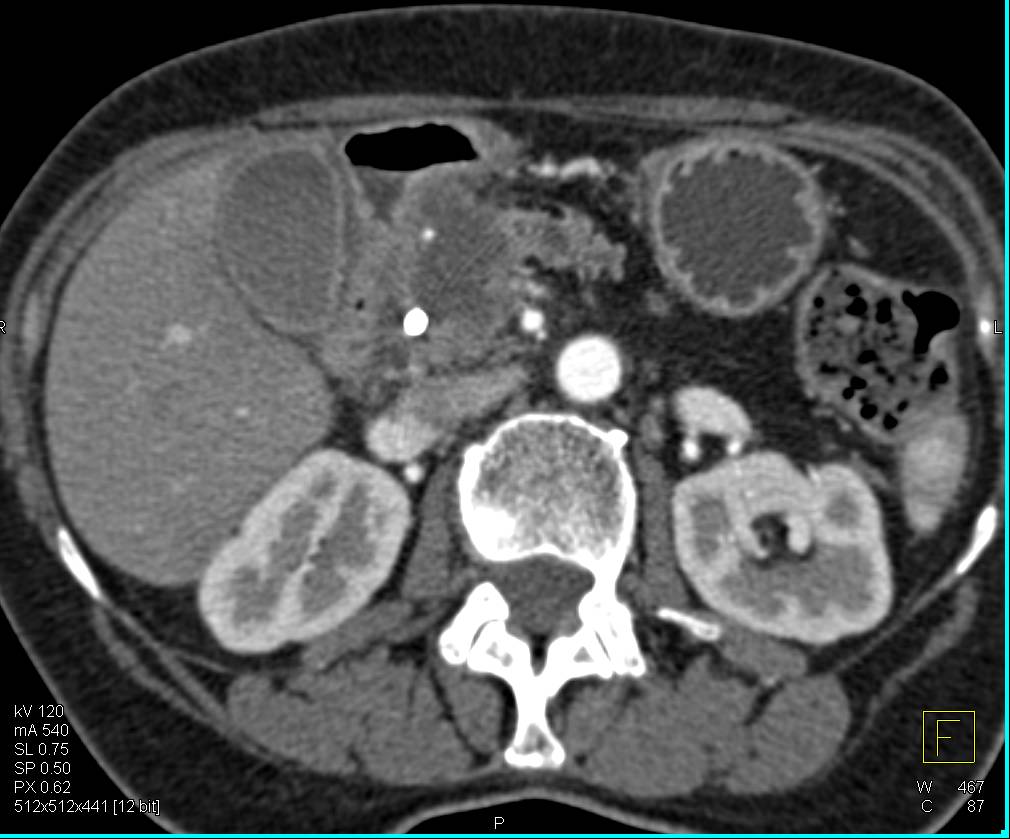 Pancreatic Adenocarcinoma PV/SMV Venous Involvement - CTisus CT Scan