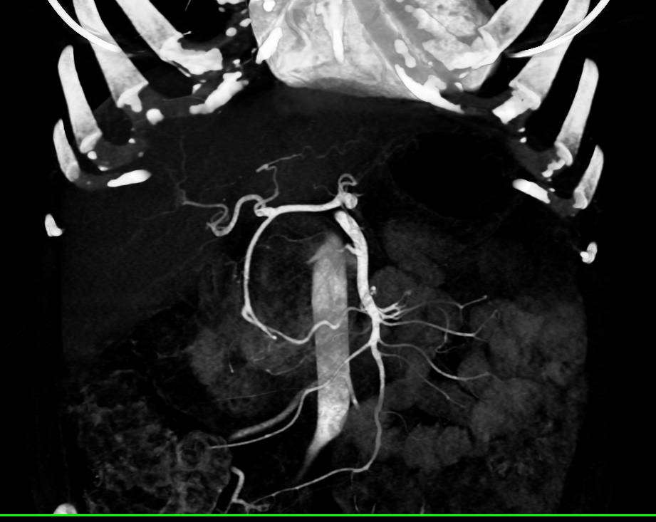 Serous Cystadenoma - CTisus CT Scan