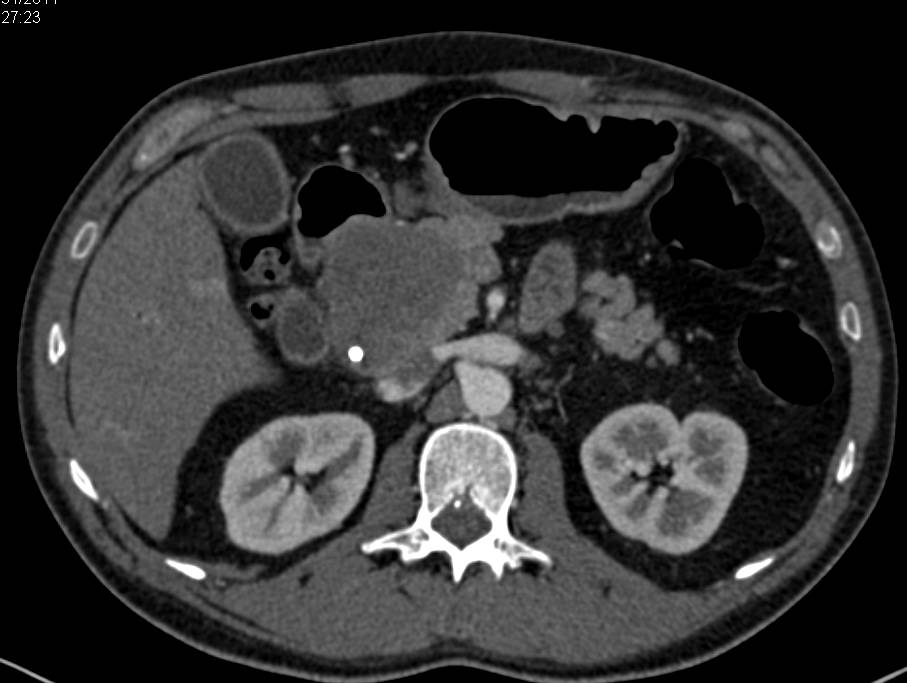 Acinar Cell Pancreatic Cancer - CTisus CT Scan