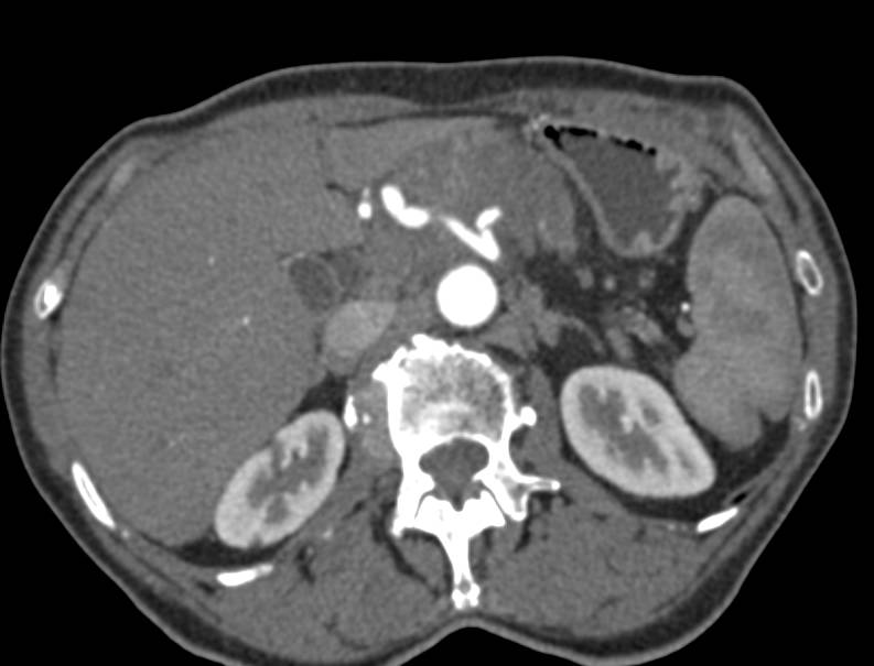 Adenocarcinoma of the Pancreas Encases the Celiac Axis Including the Hepatic and Splenic Arteries - CTisus CT Scan