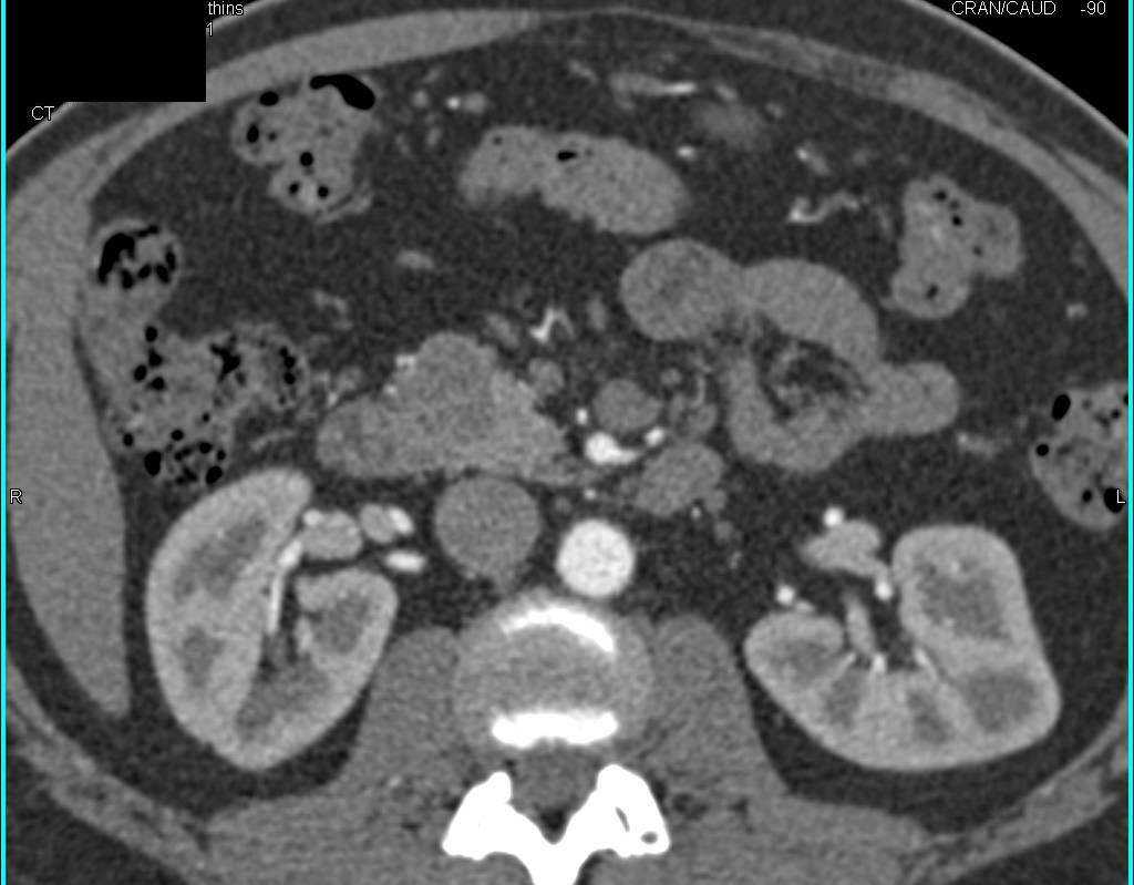 Serous Cystadenoma of the Pancreas - CTisus CT Scan