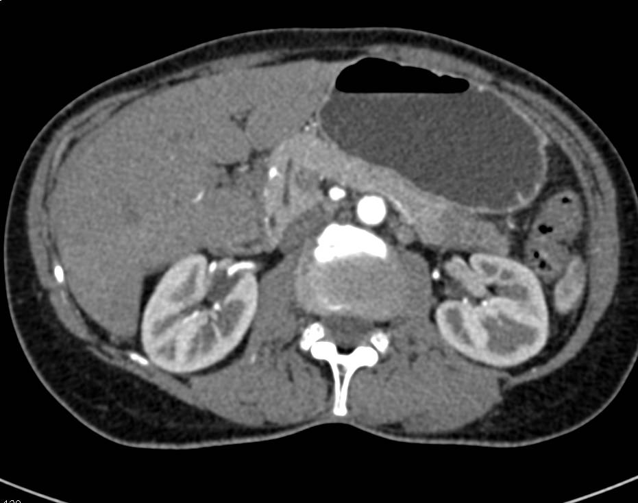 Subtle Pancreatic Cancer in the Tail of the Pancreas - CTisus CT Scan