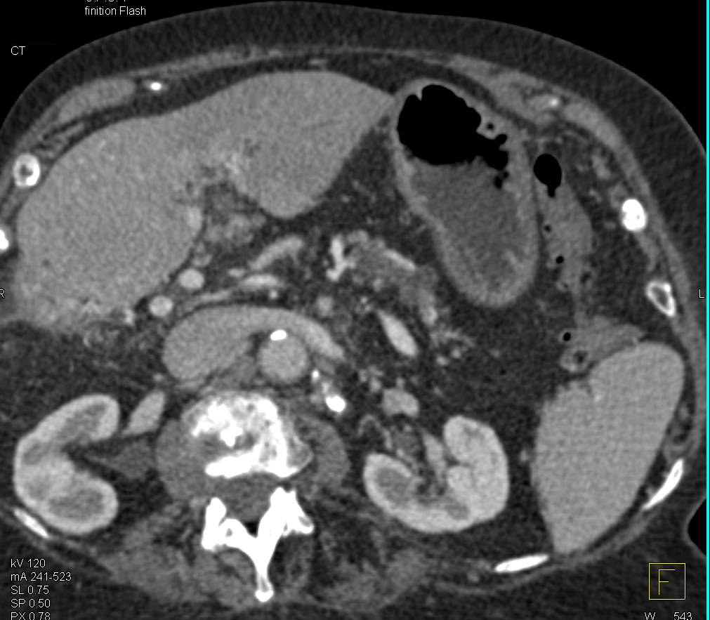 Subtle Pancreatic Cancer Obstructs the Pancreatic Duct with Early Vascular Invasion - CTisus CT Scan