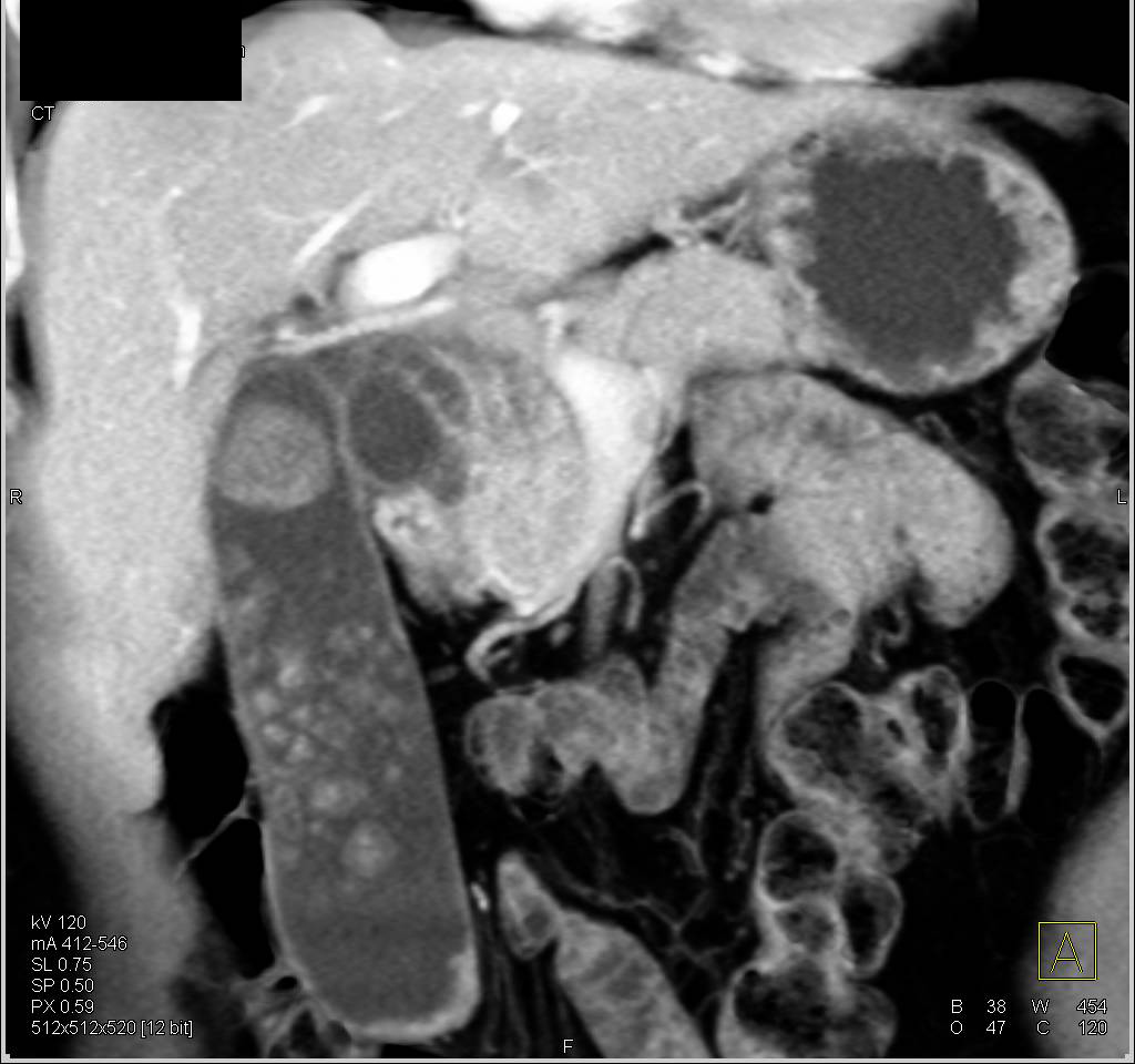 Ampullary Carcinoma and Gallstones - CTisus CT Scan