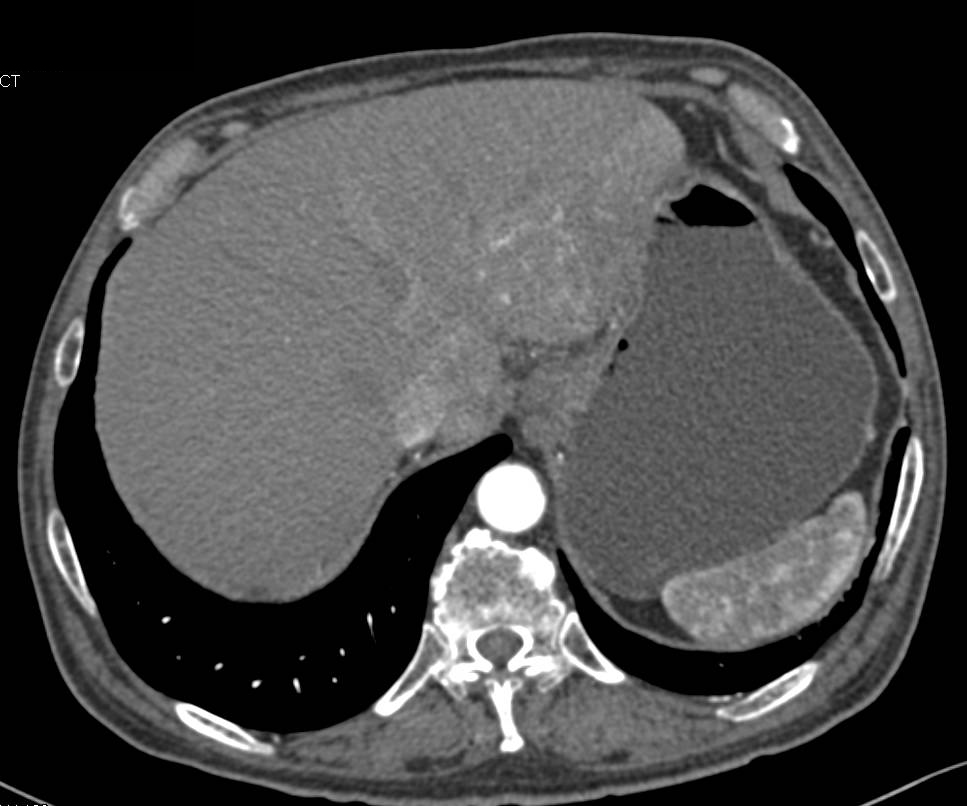 Iniltrating Tumor Body of Pancreas with Arterial and Venous Involvement - CTisus CT Scan