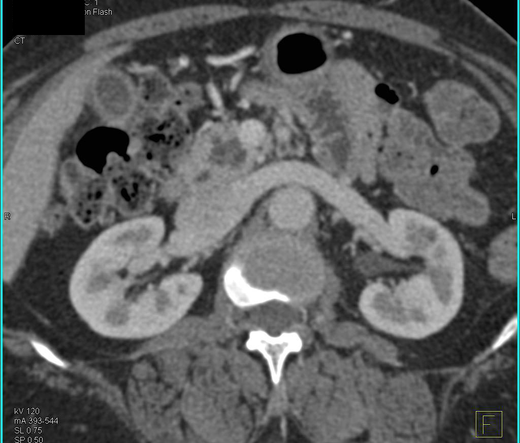 Cystic Intraductal Papillary Mucinous Neoplasm (IPMN) in the Head of Pancreas with Collateral vessels due to Marked Celiac Stenosis due to Median Arcuate Ligament - CTisus CT Scan