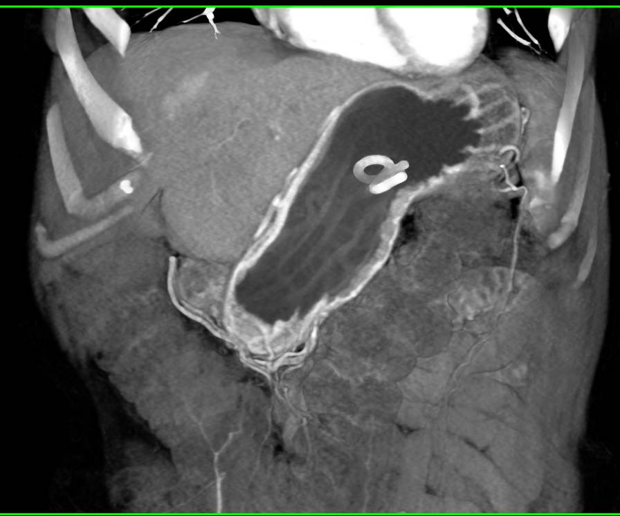 Cystogastrostomy with Good Visualization of Pigtail Catheter into Pseudocyst - CTisus CT Scan