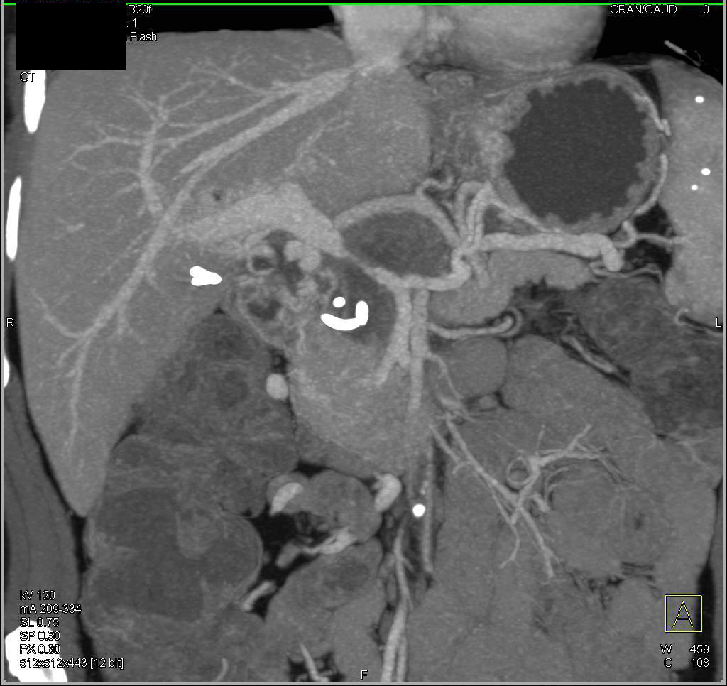 Mucinous Cystadenocarcinoma with Encasement of Portal Vein and Superior Mesenteric Vein (SMV) - CTisus CT Scan