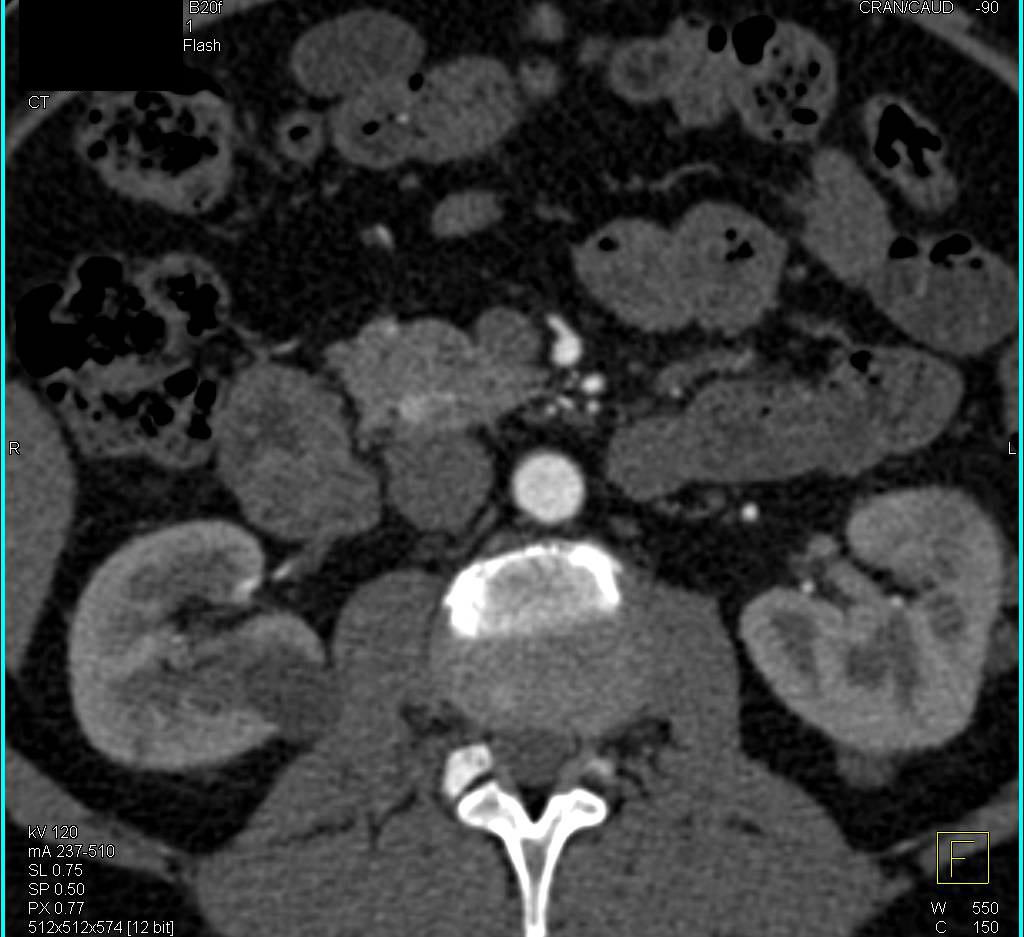 Neuroendocrine Tumor in Head of Pancreas (5 mm) - CTisus CT Scan