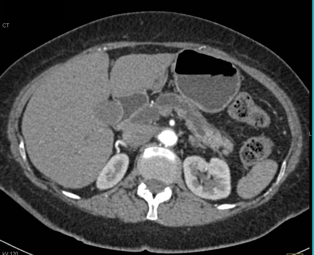 Cystic Intraductal Papillary Mucinous Neoplasm (IPMN) in the Head of Pancreas with High Grade Dysplasia and Obstructing Common Bile Duct (CBD) and Pancreatic Duct - CTisus CT Scan