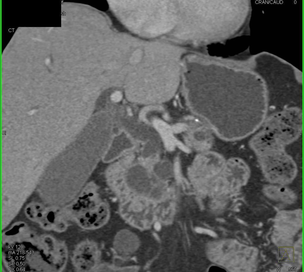 Pancreatic Adenocarcinoma With Duct Obstruction - CTisus CT Scan