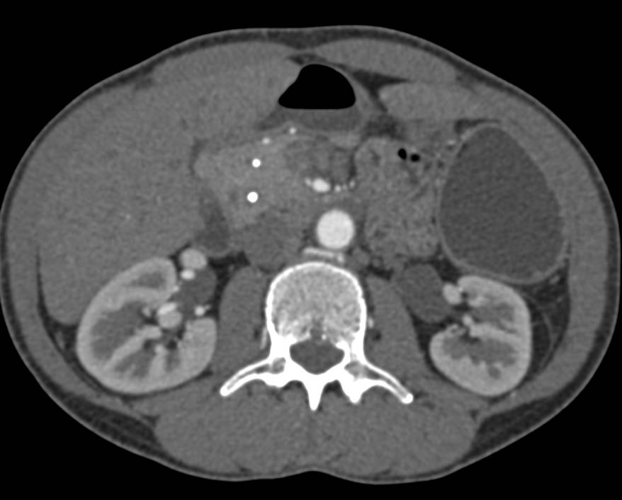 Pancreatic Duct Stent - CTisus CT Scan