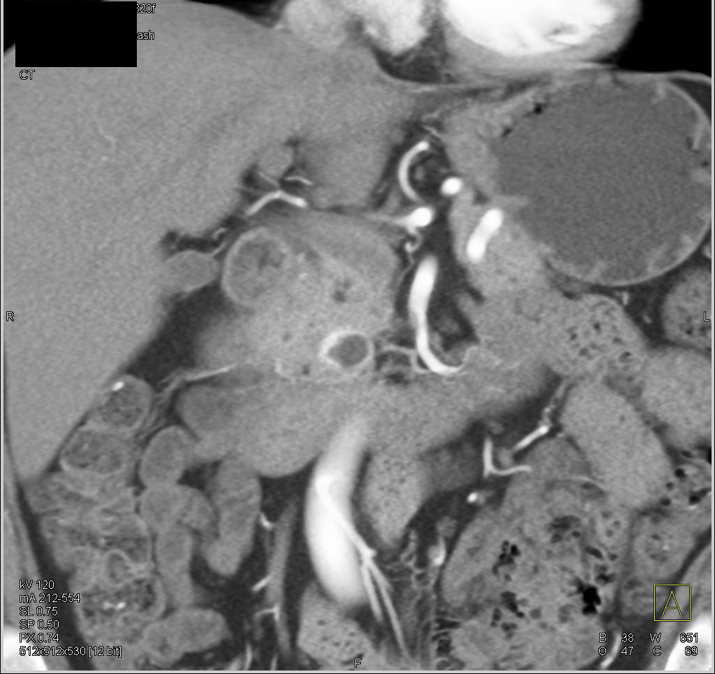 Cystic Neuroendocrine Tumor in 1cm Range in the Head of the Pancreas - CTisus CT Scan