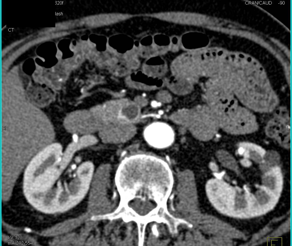 Cystic Neuroendocrine Tumor in 1cm Range in the Head of the Pancreas - CTisus CT Scan