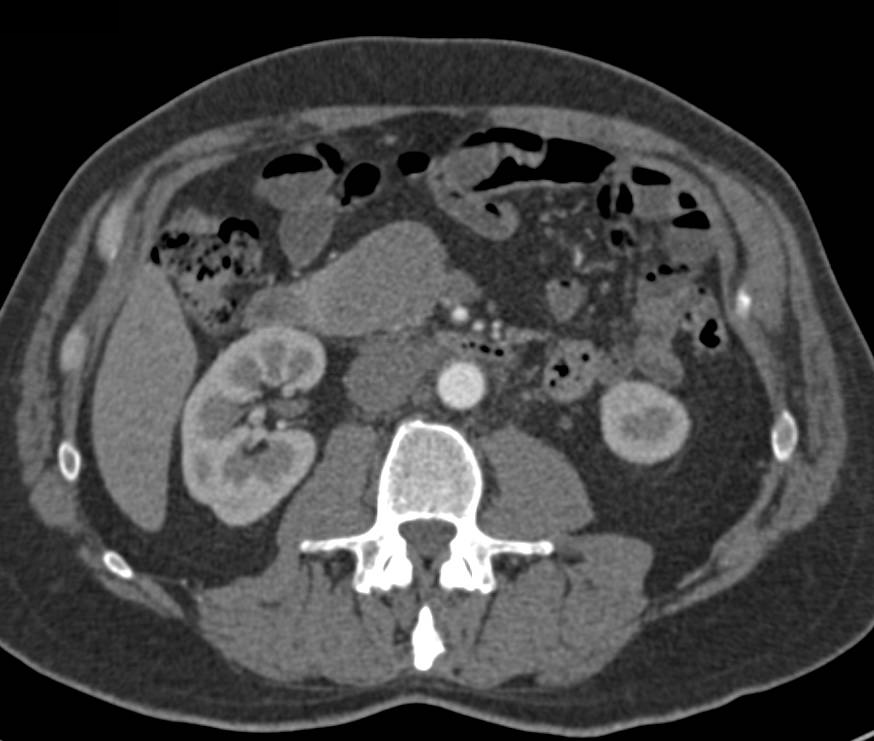 Neurogenic Tumor Simulates a Pancreatic or Duodenal Mass - CTisus CT Scan