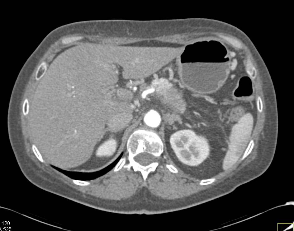 Carcinoma of the Pancreas with Portal Vein Thrombosis and Cavernous Transformation of the Portal Vein (CTPV) - CTisus CT Scan