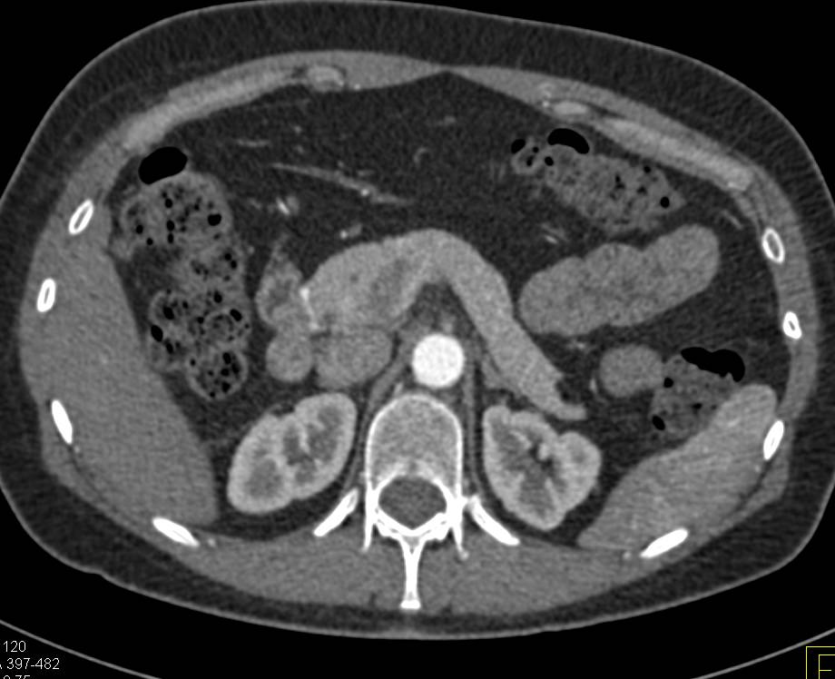 Lipoma in Tail of Pancreas - CTisus CT Scan