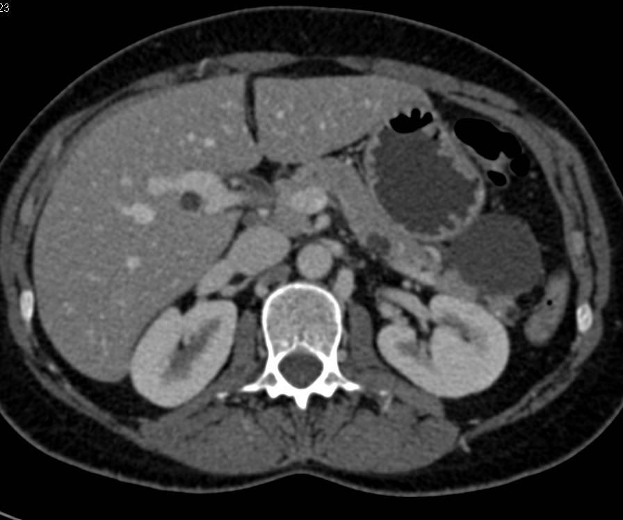 MCN (Mucinous Cystic) in Tail of the Pancreas - CTisus CT Scan