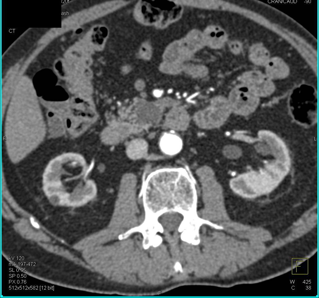 Intraductal Papillary Mucinous Neoplasm (IPMN) in Uncinate Process - CTisus CT Scan