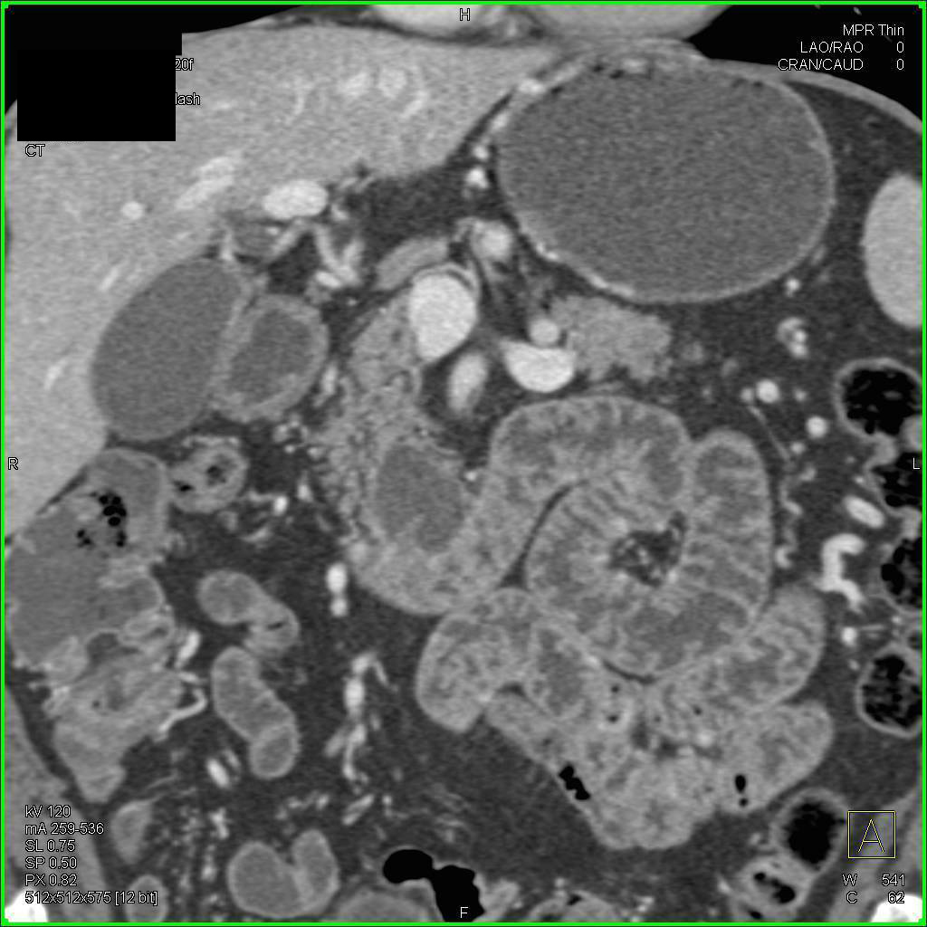 Intraductal Papillary Mucinous Neoplasm (IPMN) in Uncinate Process - CTisus CT Scan