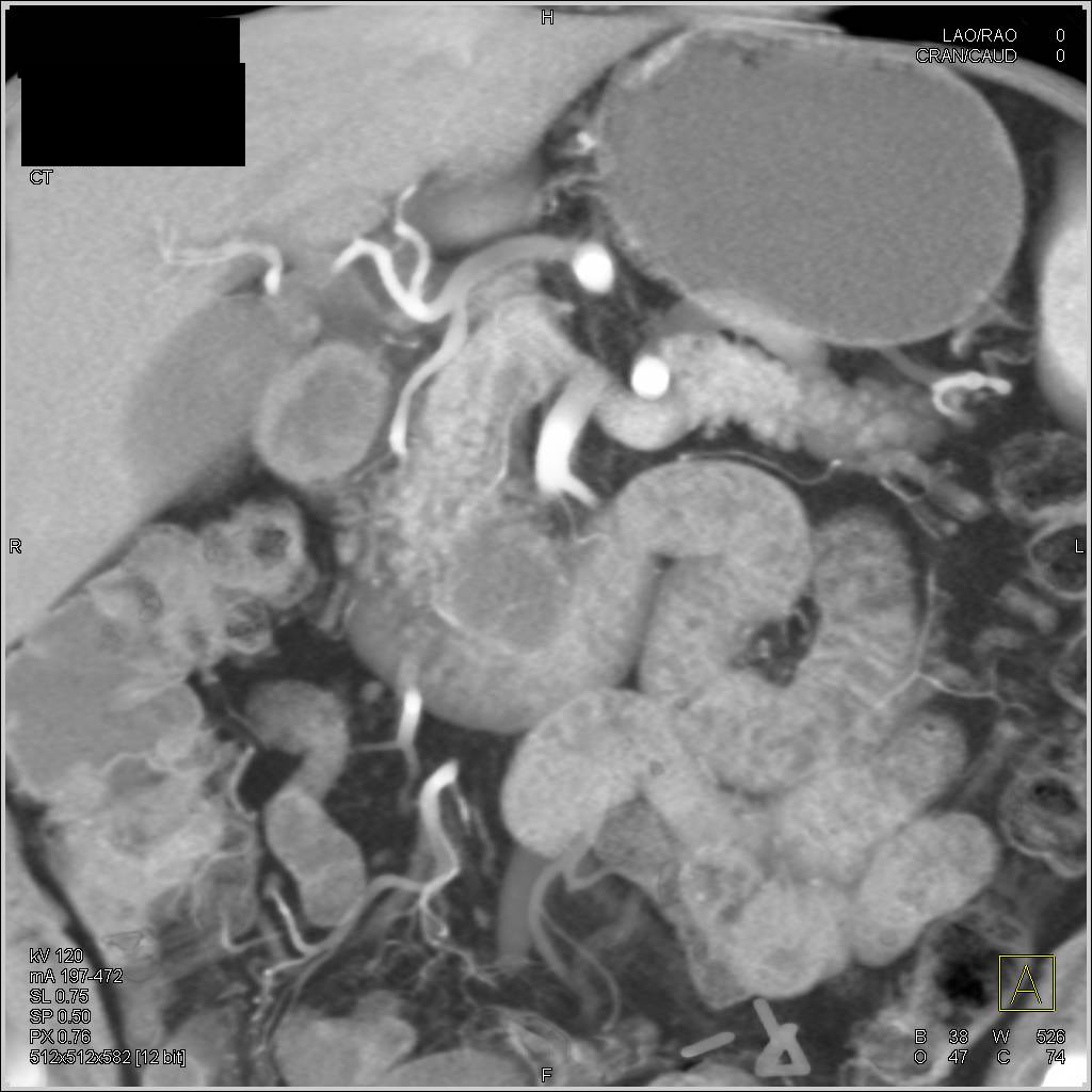 Intraductal Papillary Mucinous Neoplasm (IPMN) with Dysplasia at Pathology - CTisus CT Scan