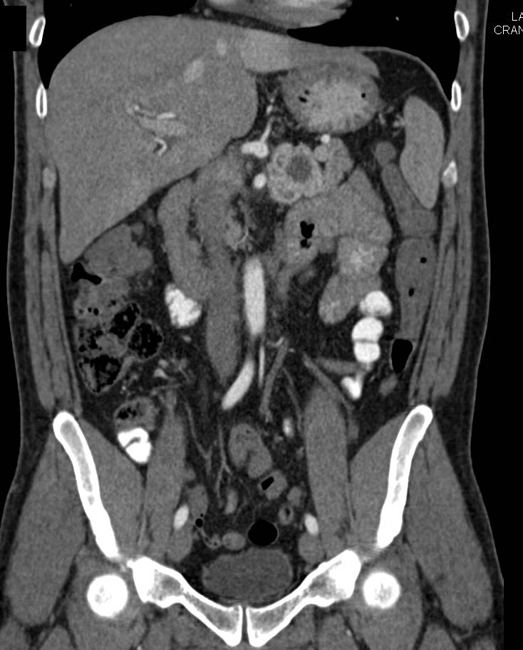 Neuroendocrine Tumor with Vascular Liver Metastases - CTisus CT Scan