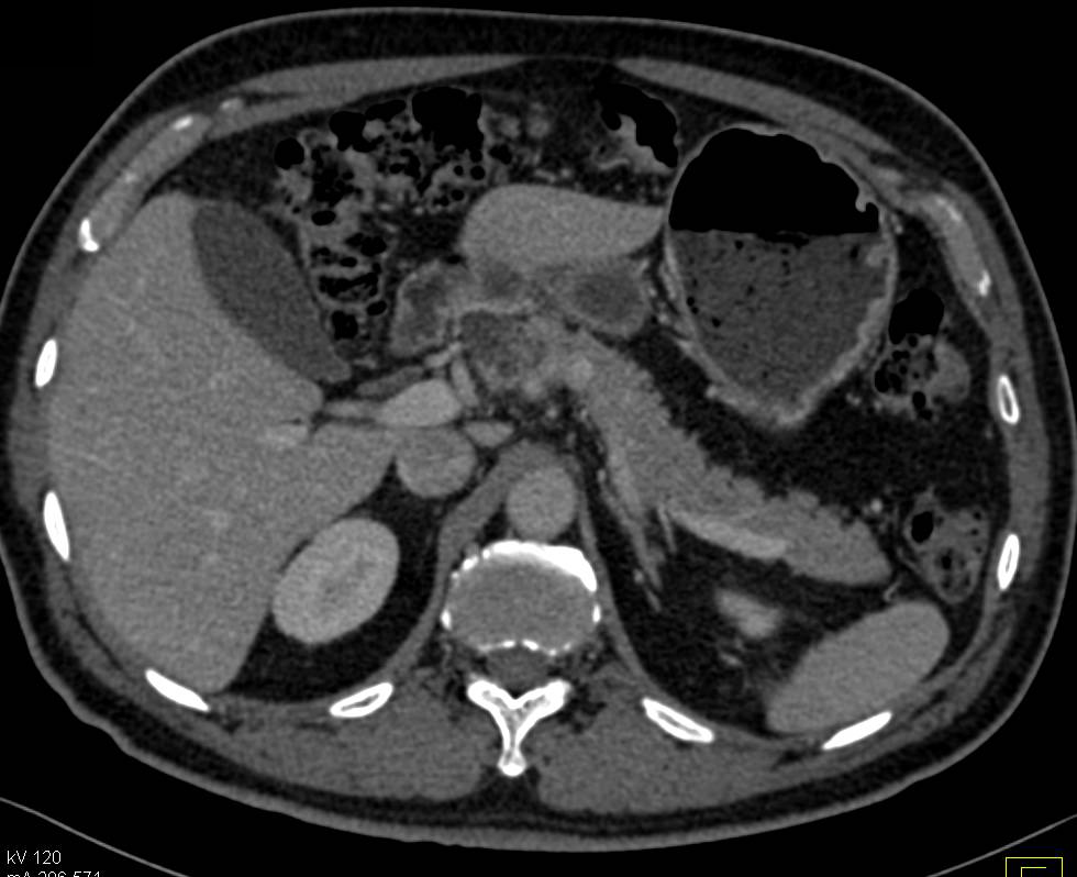 Intraductal Papillary Mucinous Neoplasm (IPMN) with Subtle Nodularity - CTisus CT Scan