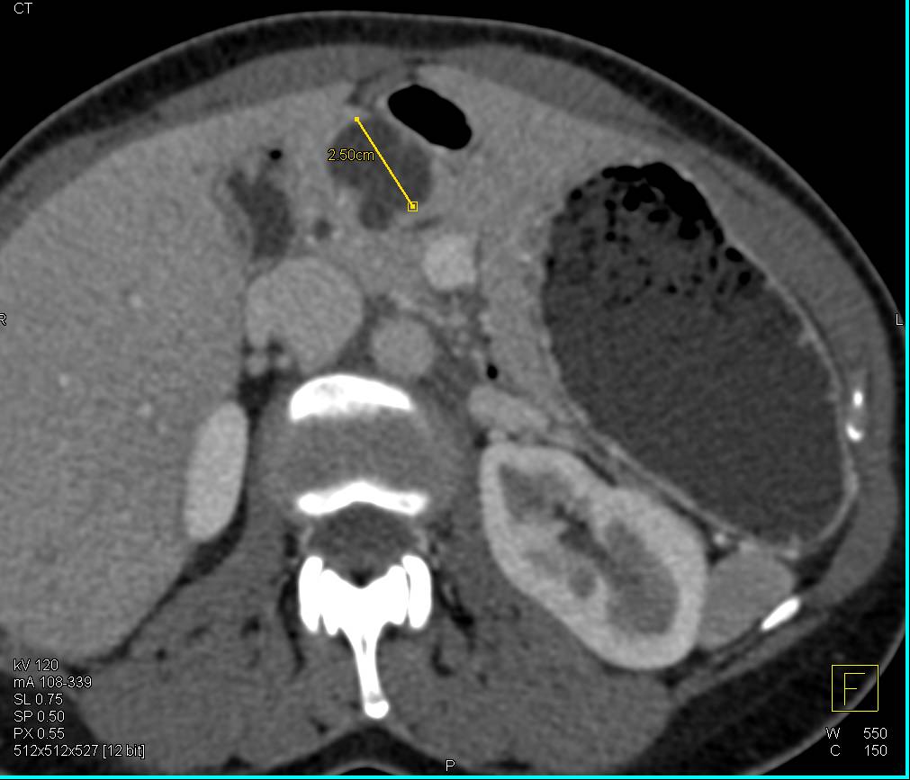 Intraductal Papillary Mucinous Neoplasm (IPMN) with Septation - CTisus CT Scan