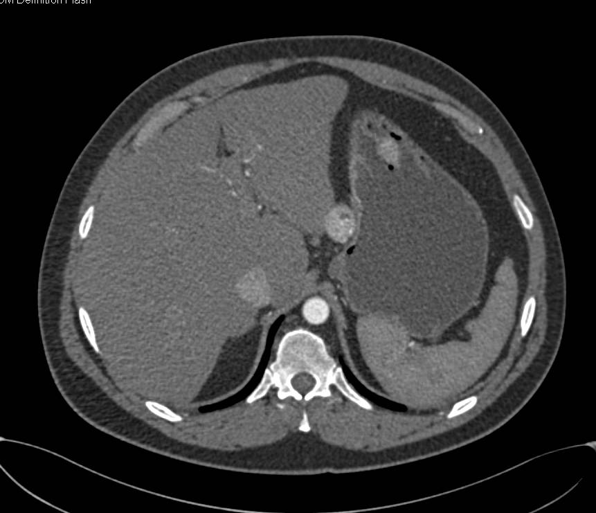 Neuroendocrine Tumor Near the Pancreas - CTisus CT Scan