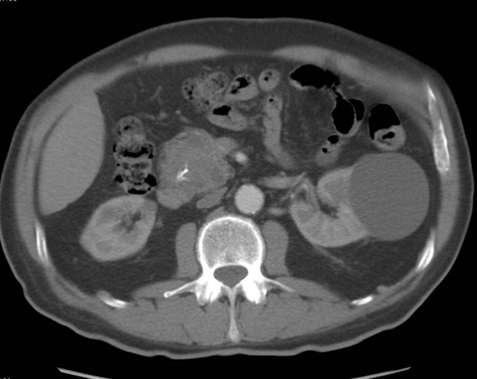 Pancreatic Adenocarcinoma With Mass in Head of Pancreas - CTisus CT Scan