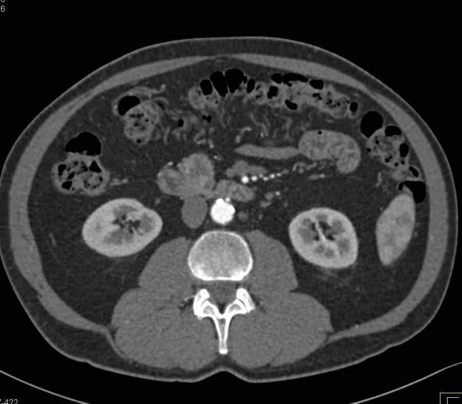 Neuroendocrine Tumor in the Head of the Pancreas - CTisus CT Scan