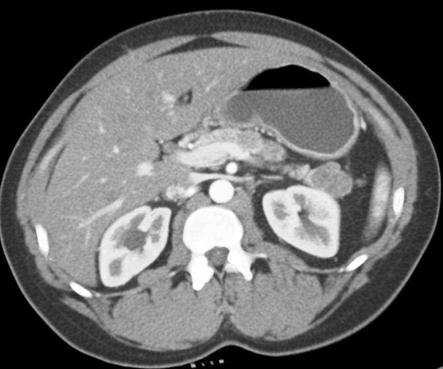 Cystadenoma in the Tail of the Pancreas - CTisus CT Scan