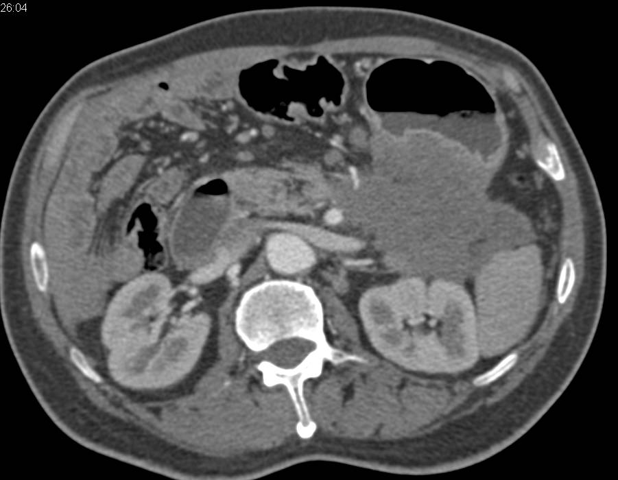 Carcinoma of the Tail of the Pancreas - CTisus CT Scan