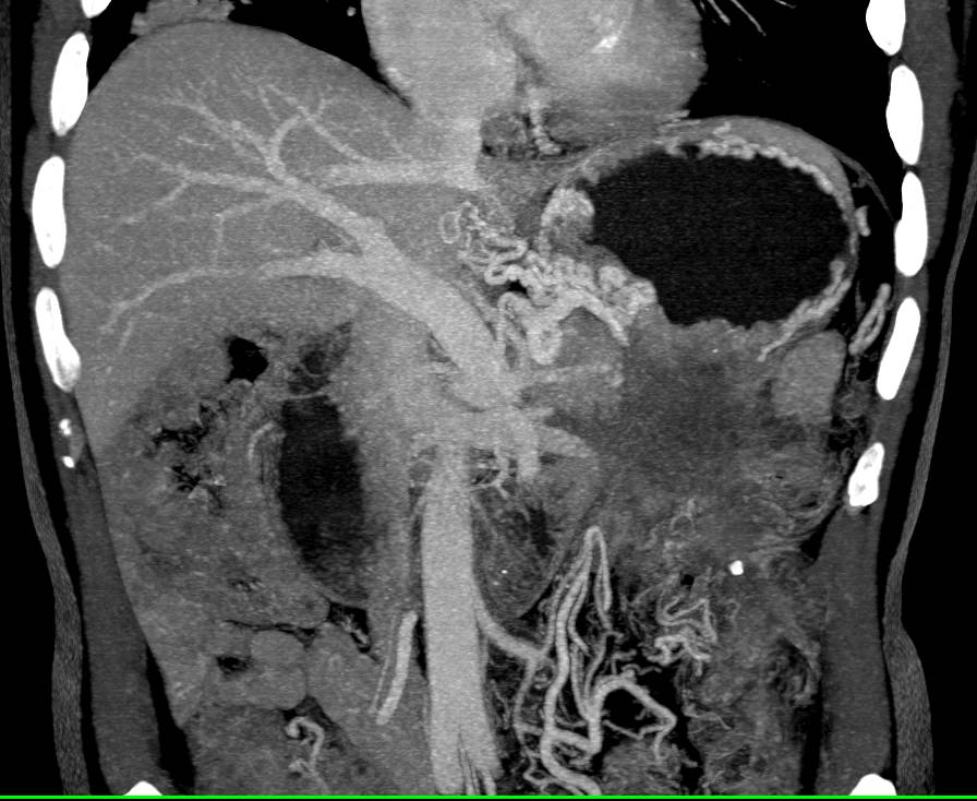 Carcinoma of the Tail of the Pancreas Presenting as Obstructing the Small Bowel at the Ligament of Trietz - CTisus CT Scan