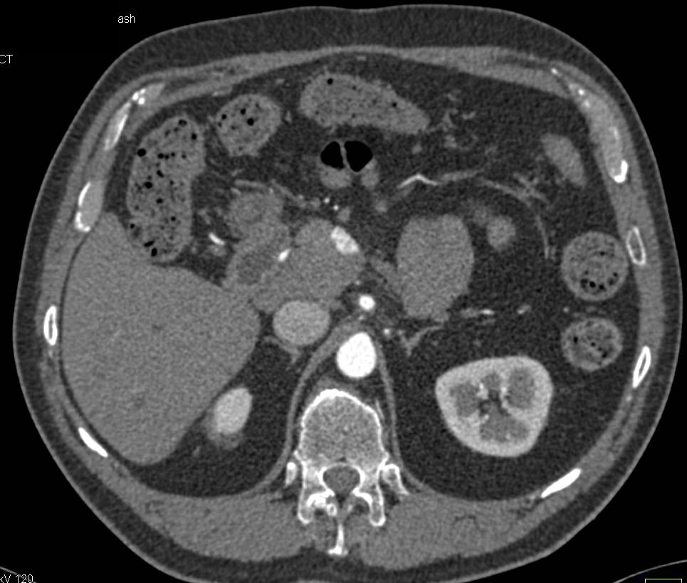 Neuroendocrine Tumor of the Pancreas - CTisus CT Scan