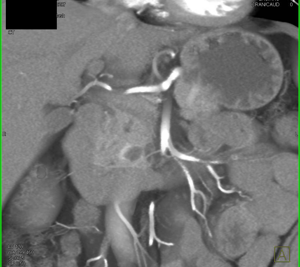 Cystic Neuroendocrine Tumor of the Pancreatic Head with Enhancement on Arterial Phase - CTisus CT Scan